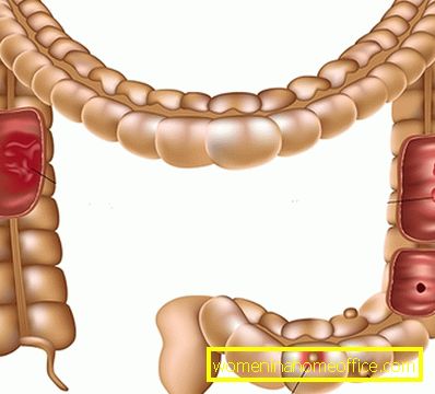 perturbation de l'équilibre de la microflore intestinale